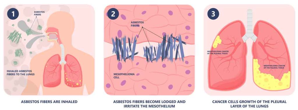 Asbestos Causes Cancer. Fibers are inhaled, Asbestos fibers become lodged in the lung and cancer cells grow.